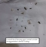 Pengalaman Membersihkan Karang Gigi Secara Alami